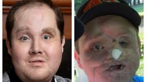 Fundraiser by Lisa Pfaff : Help Derek fund his face transplant.