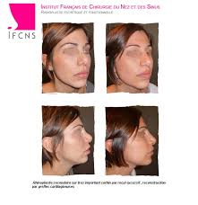 Tunisie chirurgie esthetique, tce, est une agence de tourisme médical spécialisée dans l'organisation des séjours de chirurgie. Quel Est Le Cout Tarif D Une Rhinoplastie Ou D Une Septorhinoplastie Lyon Chirurgien Expert En Rhinoplastie A Paris Institut Rhinoplastie