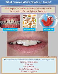 In most cases, if you are choosing any of the above methods, then it shouldn't take too long to see a difference in your teeth.' bleaching may take a little longer as the teeth lift, as oppose to veneers. White Spots On Teeth How To Get Rid Of White Stains On Teeth