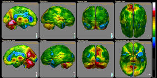 The food and drug administration has approved ecitalopram for the treatment of gad. My Brain After Long Term Lexapro Chemically Induced Tbi Hormones Matter