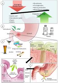 Perforated Peptic Ulcer Abstract Europe Pmc