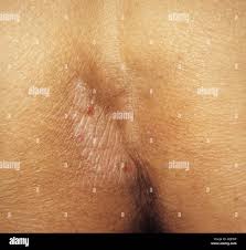 Image result for Lichen Simplex Chronicus