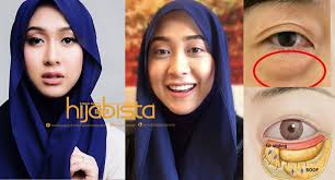 Kamu bisa mengompres hangat bagian mata yang sakit dan menggunakan salep mata salah satu penyebab mata bengkak yang cukup umum adalah kurang tidur loh! 10 Cara Atasi Masalah Kantong Mata Atau Eye Bag Tanpa Solekan Tebal 10 Berkesan Sekiranya Kecemasan Hijabista