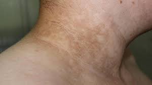 Acantosis Nigricans Sintomas Causas Y Como Tratar La Enfermedad