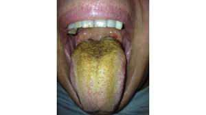 Image result for brown tongue symptoms