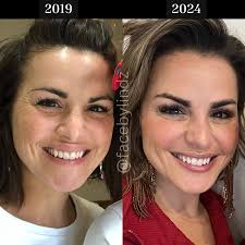 ✨💉 Choose Wisely: Your Aesthetic Injector Matters! 💉✨ When it comes to  your beauty journey, the injector you choose makes all the difference!  Here's why it's crucial to pick wisely: 🎓 **Licensed