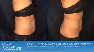 Pin On Sculpsure