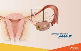 Esterilizacion Metodos Anticonceptivos Orientame