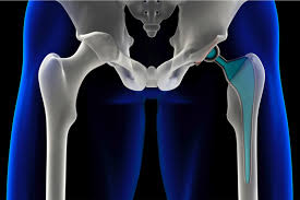 Depuy Pinnacle Hip Implant Lawsuit Sanders Phillips Grossman