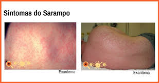 Watch our new video to learn what will happen to our body if we are infected with this disease. Sintomas Do Sarampo