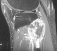 Image result for Leiomyosarcoma