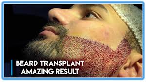 The technique is primarily used to treat male pattern baldness. Fue Surgery Beard Transplant Amazing Results Before After Youtube