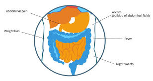 If the cancer has spread beyond the mesothelium to other parts of the body, symptoms may include pain, trouble. Mesothelioma Symptoms Early Warning Signs Of Abestos Cancer