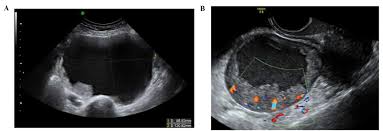 Ovarian cancer is the second most common gynecologic malignancy and is the fifth leading cause of 7 color and pulsed doppler ultrasound have also been used in the evaluation of ovarian masses. The Characteristic Ultrasound Features Of Specific Types Of Ovarian Pathology Review