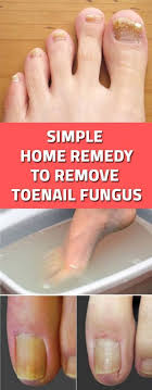 Simple Home Remedy To Remove Toenail Fungus Toenail Fungus Home Remedies Toenail Fungus Remedies Toenail Fungus