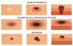 What your dermatologist removes will be looked at under a microscope. Spotting Skin Cancer Union Health Center