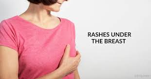 Image result for heat rash under breasts