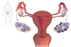 Learn more about pcos, including how it affects a. Polycystic Ovary Syndrome Market Poised For Tremendous Growth Top Pharma Inc To Foray Are Bayer Ag Abbott Astrazeneca Biocinese Novartis Insight 2018 2023 Medgadget