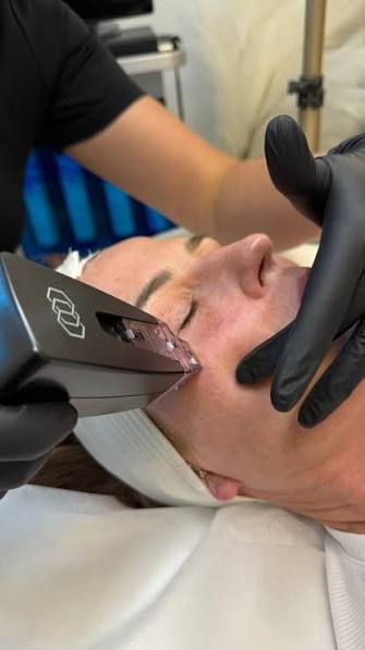 Morpheus 8 Vs Regular Microneedling? One of the primary differences between  Morpheus8 and microneedling is the depth at which they target skin  concerns. Microneedling focuses on the superficial layers of the skin,