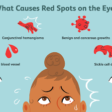 Maybe you would like to learn more about one of these? Possible Causes Of A Red Spot On Your Eye