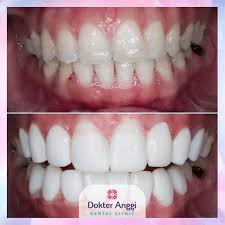 Jadi veneer gigi merupakan suatu prosedur melapisi gigi dengan bahan tertentu (komposit atau banyak selebriti indonesia yang ikut meramaikan tren veneer gigi. Dokter Anggi Dental Clinic Veneer Composite 8 Gigi Terbaru Agustus 2021 Harga Murah Kualitas Terjamin Blibli