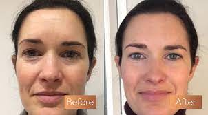 Experts and users cite many reasons they include a collagen supplement in their routine. Absolute Collagen Before And After Pictures Incredible Results