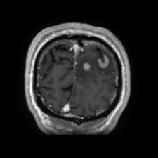 Image result for Neurosyphilis
