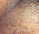 Ingrown Hair Cyst Under Skin
