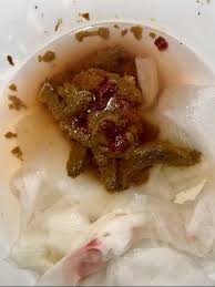 Image result for blood in stool human poop