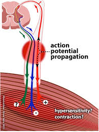 Evaluating Of Trigger Point Phenomenon Body In Mind