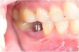 With insurance, about 50 percent of the cost of the entire. History Of Dental Implants