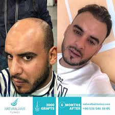 Accredited hair clinic & cosmetic specialist in turkey. Hair Transplant Turkey Istanbul Reviews