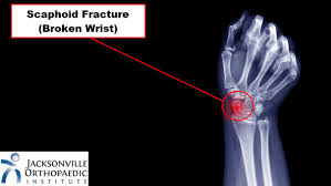 Image result for Fracture