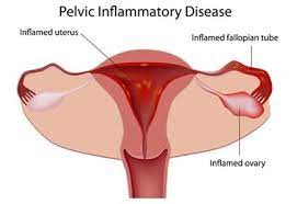 Pelvic Inflammatory Disease Pid Causes Signs Ayurvedic Treatment