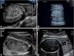 Figure 3 From Prenatal Ultrasound Genotype And Outcome In A Large Cohort Of Prenatally Affected Patients With Autosomal Recessive Polycystic Kidney Disease And Other Hereditary Cystic Kidney Diseases Semantic Scholar