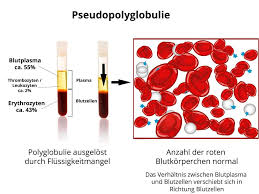 Erythrozyten Zu Hoch Blutwert Erys Erhoht Ursachen