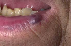 A cherry angioma is removed by touching the spot with an electric needle, which destroys and breaks up the blood vessels.; Venous Lake Wikipedia