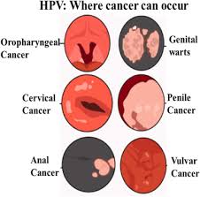 Image result for human papillomavirus symptoms