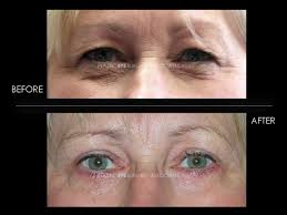 Plastic Eye Surgery Associates Houston The Woodlands Pensacola Destin Eye Surgery Plastic Surgery Eyes
