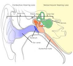 How To Read An Audiogram And Determine Degrees Of Hearing Loss