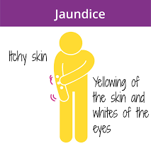 Of course, your specialist is the main person whose advice you should follow but it doesn't do anyone harm. Jaundice Medium Website Size Pancreatic Cancer Action