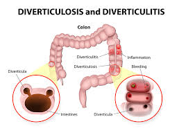 Aceasta nu trebuie confundata cu sindromul de intestin iritabil, care este mai putin sever. Boala Diverticulara A Colonului Diverticuloza Si Diverticulita Reginamaria Ro