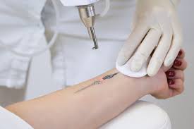 According to the american society for aesthetic plastic surgery, the national average cost of laser removal is. Laser Treatment Tattoo Removal How To Do It