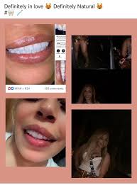 Veneers with translucent appearance, affordable options?