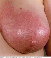 Inflammatory breast cancer symptoms and signs include pain or a bruise in the breast, skin changes in the breast area, sudden swelling of the what are the causes and risk factors for inflammatory breast cancer? Mastitis Symptoms And Causes Mayo Clinic