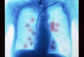 With proper treatment, even more advanced stage 3 testicular cancer can be cured. Metastatic Cancer To The Lungs Symptoms And Treatment
