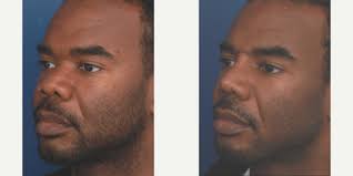 Ronald Schuster, MD Reviews, Before and After Photos, Answers