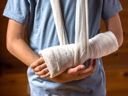 Scaphoid Fracture All About This Common Wrist Injury And Treatment
