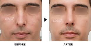 Read to learn how to get rid of and prevent nose pimples once & for all in 5 simple steps from tiege hanley. How Tip Plasty Can Help Your Nose Look More Refined Medisettermedisetter