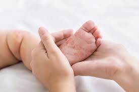 Panas yang menyerang pada bayi dapat terjadi akibat beberapa hal, seperti efek samping dari imunisasi. Anak Terkena Campak Apa Yang Harus Dilakukan Orangtua Halaman All Kompas Com